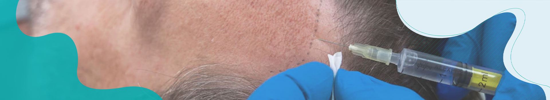FUE Hair Transplant